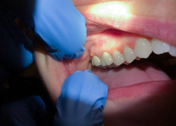 Best Emergency Gum Treatment in Portageville, MO