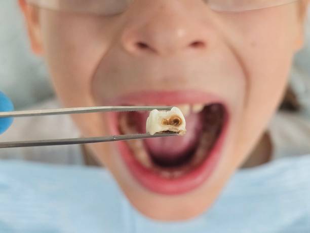 Best Emergency Wisdom Teeth Removal in Portageville, MO